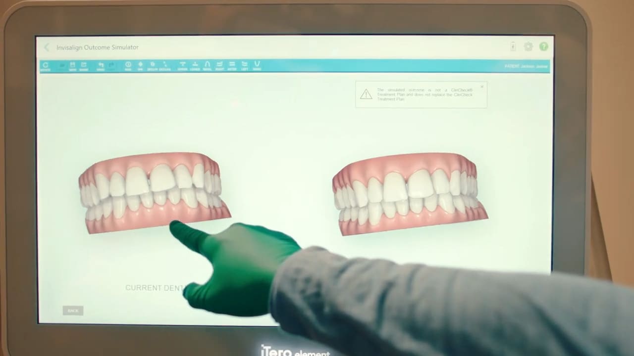 pointing to iTero scanner screen Get a precise 3D scan of your teeth with the iTero scanner.