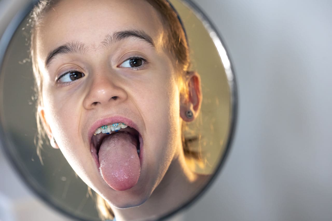girl with braces sticks out her tongue while looking in the mirror Orthodontic patient checking progress during phase 2 treatment