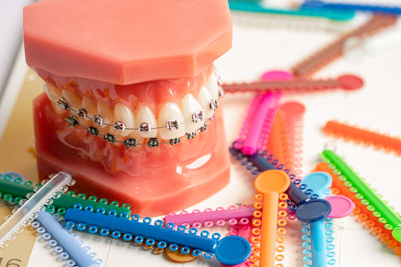 orthodontic ligatures rings and ties Dental braces with colorful ligatures, elastic ties that connect brackets to archwires.